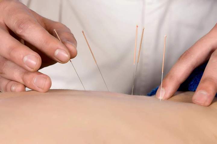 Acupuncture Miami