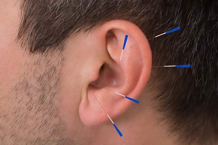 Acupuncture Miami