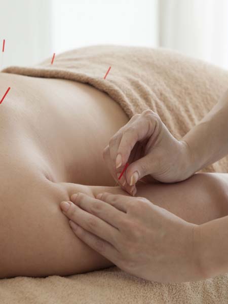 Acupuncture Miami