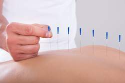 Acupuncture, Brickell